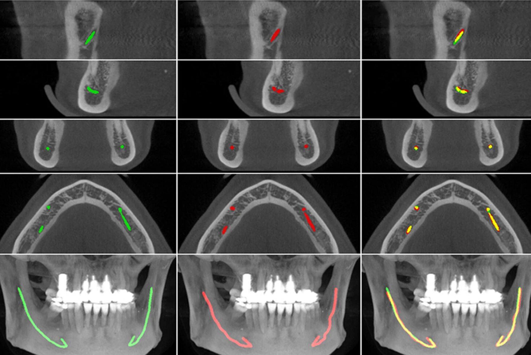 CBCT Üzerinde Anatomik Oluşumların Değerlendirilmesi