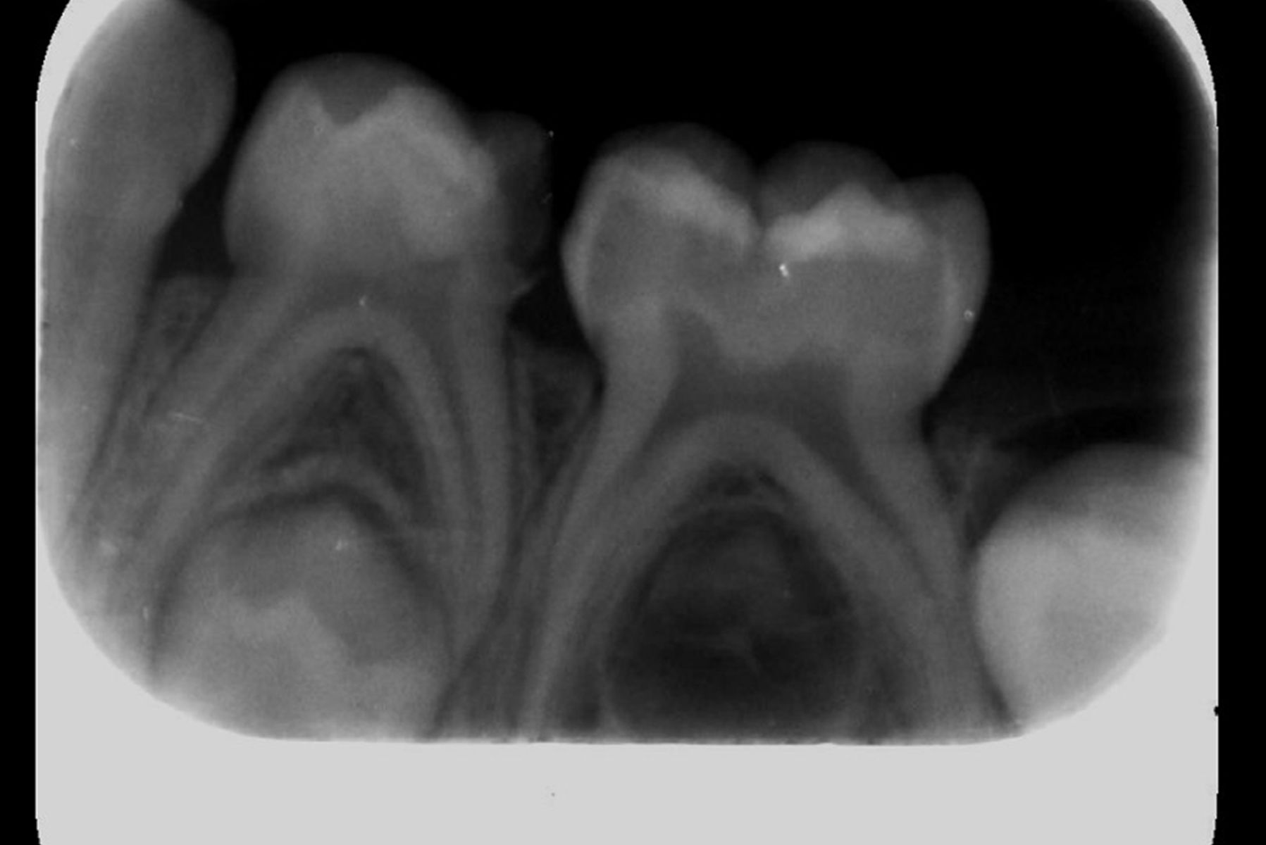 Süt Dişlerinde Endodontik Tedaviler