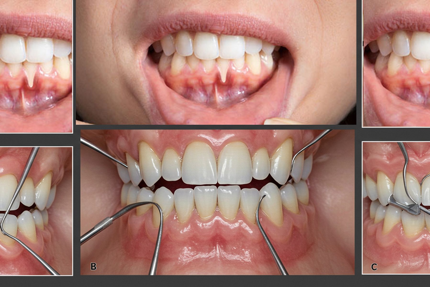 Cerrahiden Estetiğe: Mukogingival Vaka Değerlendirmesi