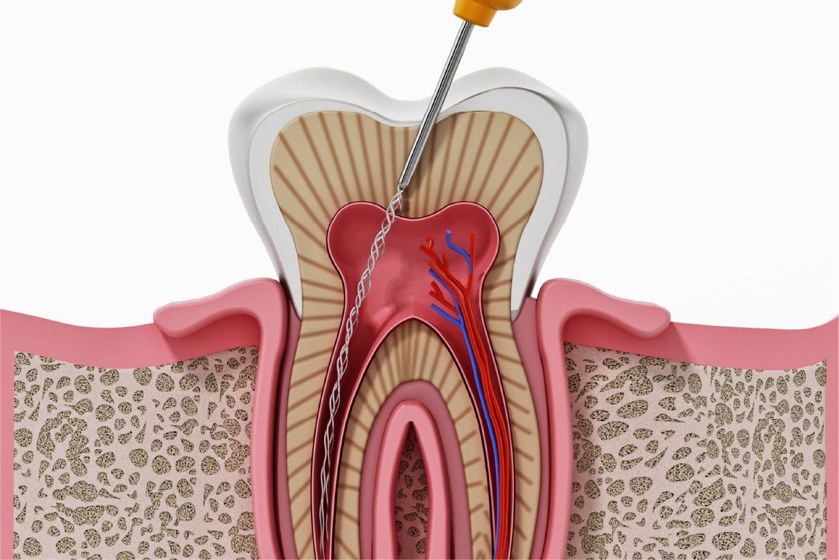 Endodonti Atölyesi Ni ti Döner Eğe Sistemi ile Kök Kanalı Genişletme ve Rubber Dam Uygulaması