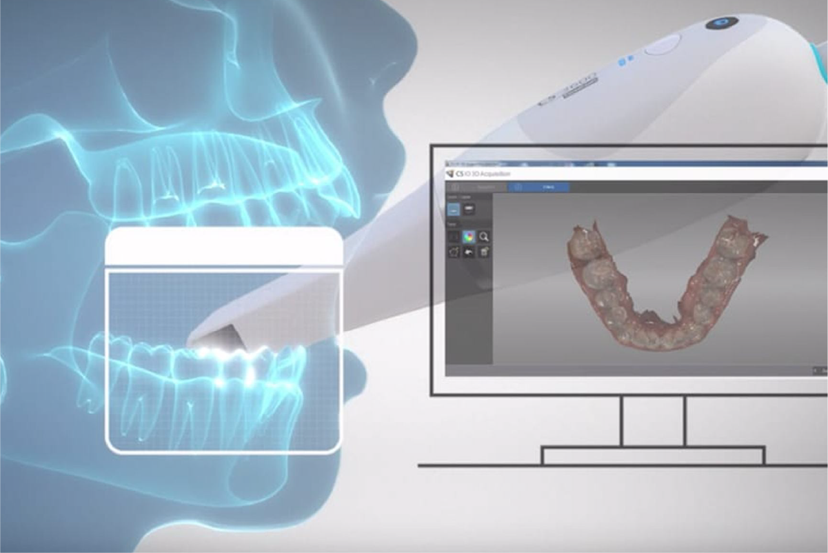 Protez Atölyesi Sabit Restorasyonlarda Dijital Ölçü
