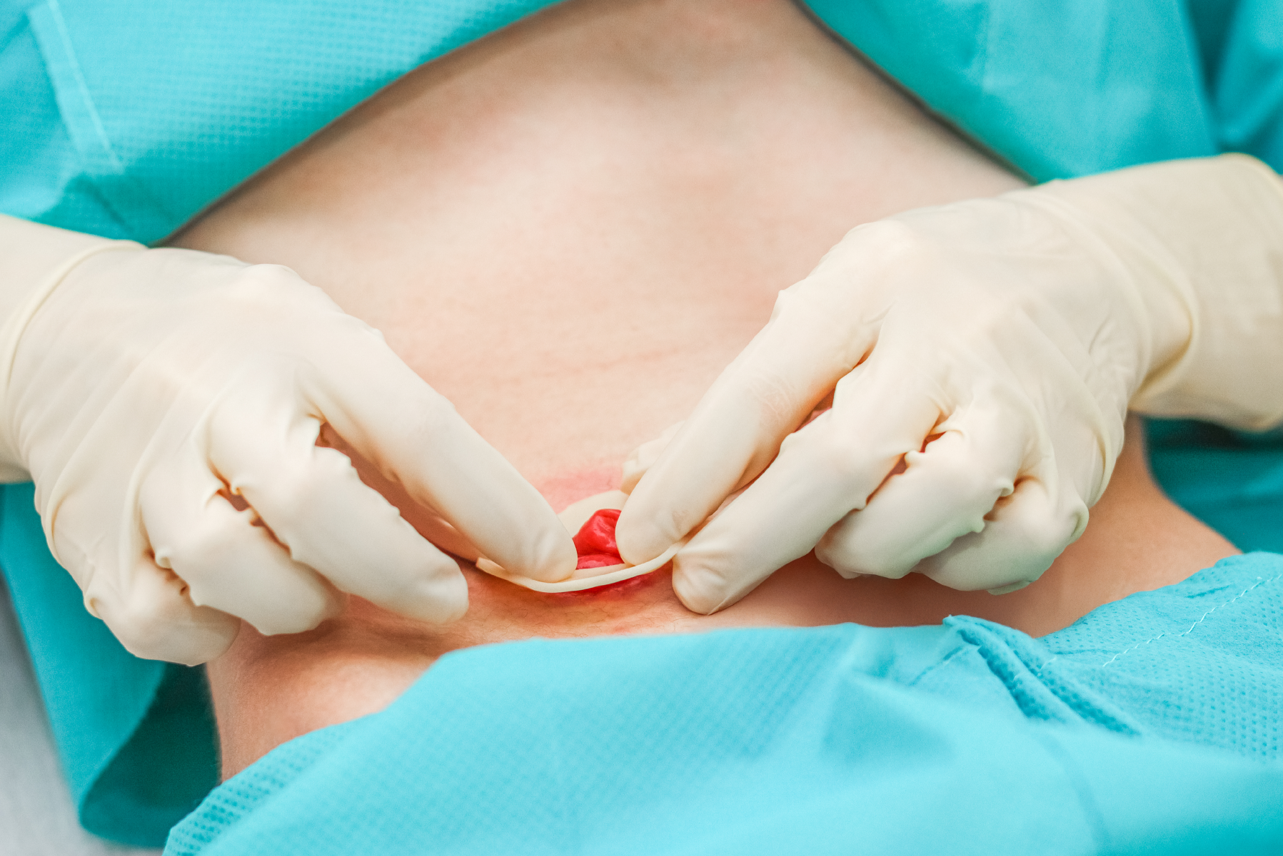 Bakımı Stomaterapi Hemşiresi İle Öğreniyoruz