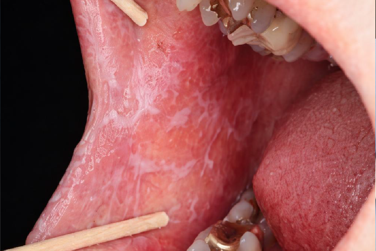 Radyoloji Atölyesi: Oral Liken Planus'a Klinik Bakış