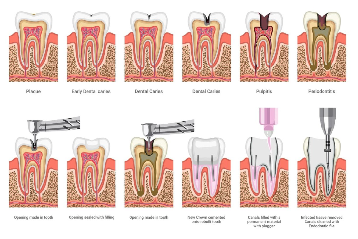 Endodonti Atölyesi: Retreatment